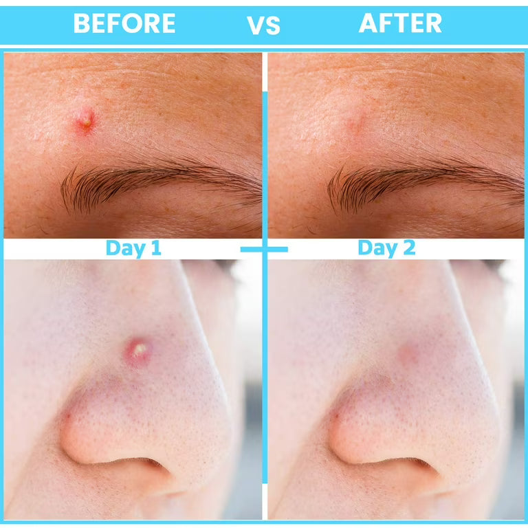 Microdart Acne Patches