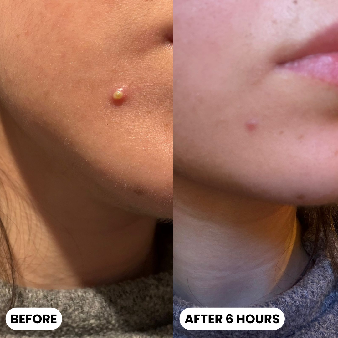 Day & Night Acne Patches