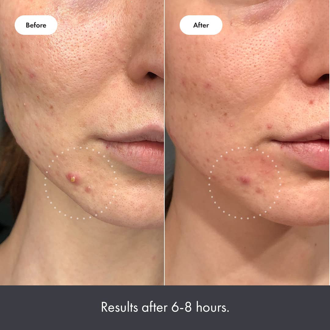 Haloskin 90-Day Clear Skin Kit