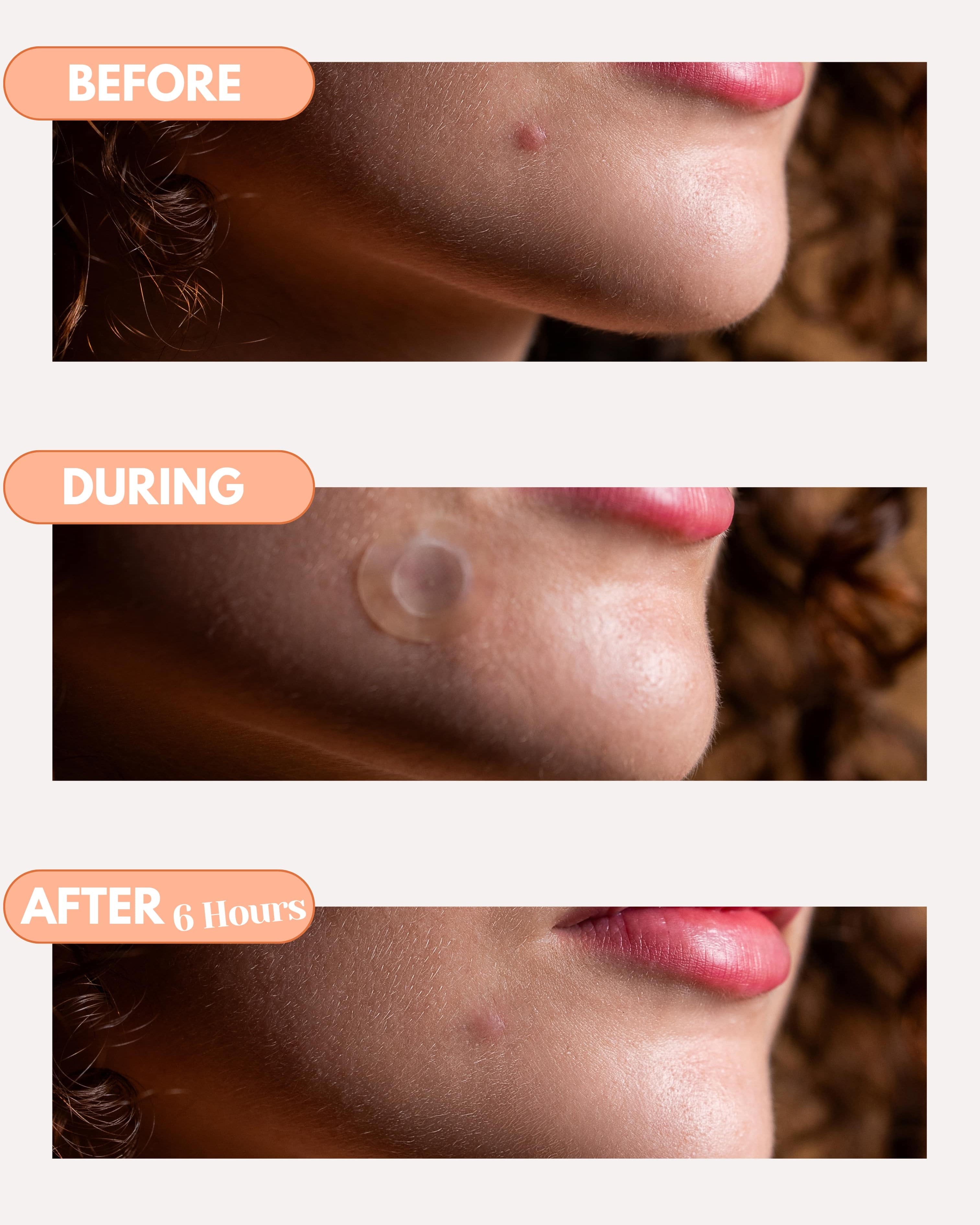 Total Acne Control Kit