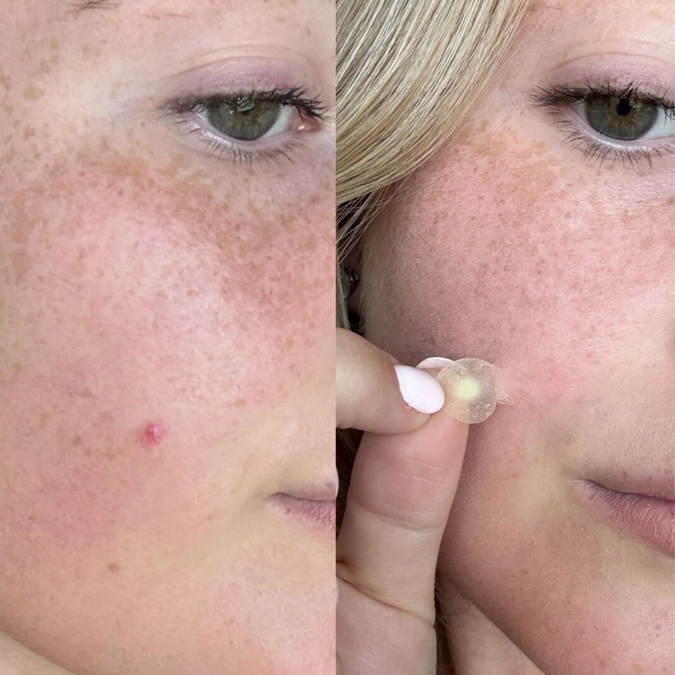 Haloskin 90-Day Clear Skin Kit