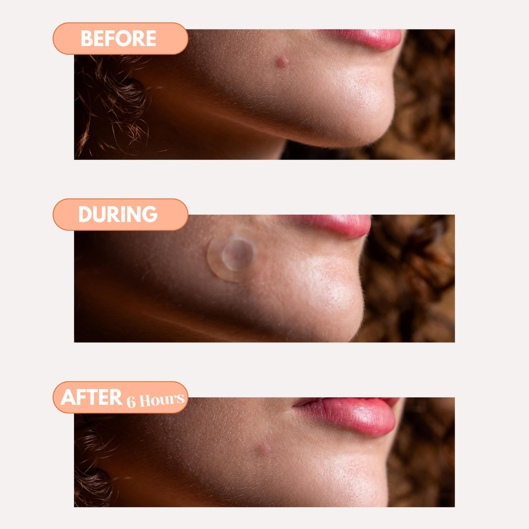 Total Acne Control Kit