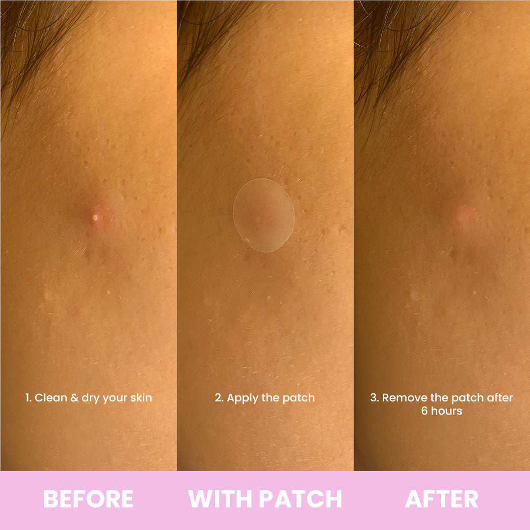 Day & Night Acne Patches