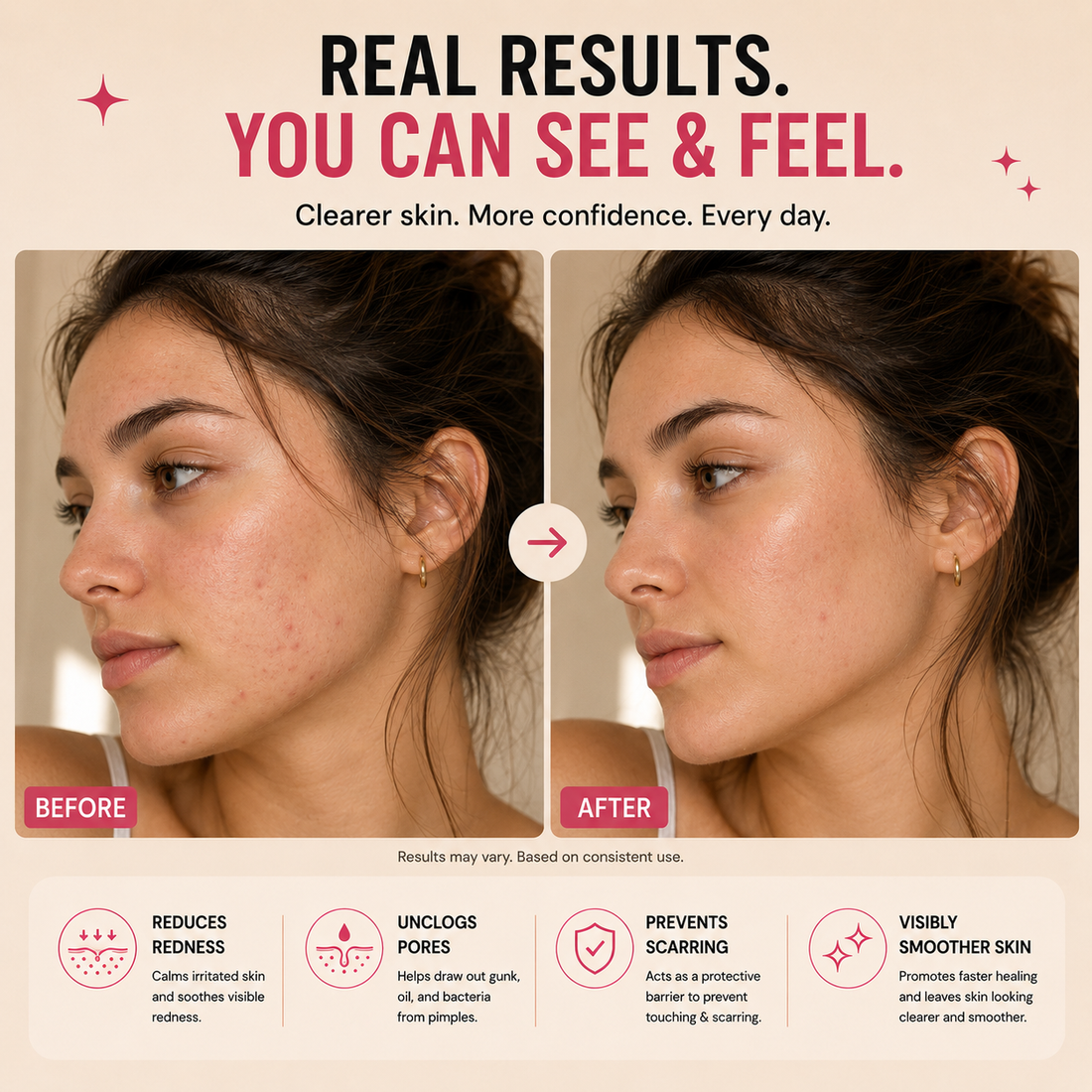 Total Acne Control Kit